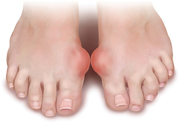 Khi bị gút, bệnh nhân thường xuất hiện hạt tophi ở mắt cá chân, ngón chân