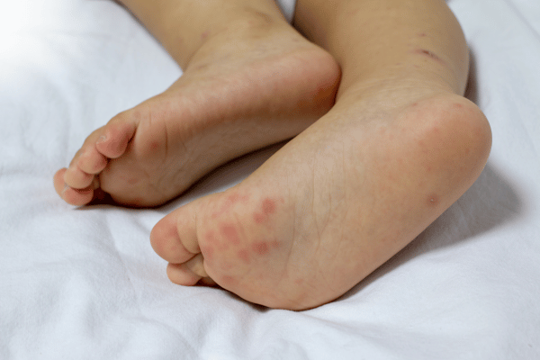 Giai đoạn khởi phát - giai đoạn đầu tiên của bệnh tay chân miệng ở trẻ
